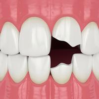 Chipped tooth reshaping in Peacehaven and Newhaven
