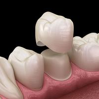 Tooth crowns Dentist in Peacehaven and Newhaven